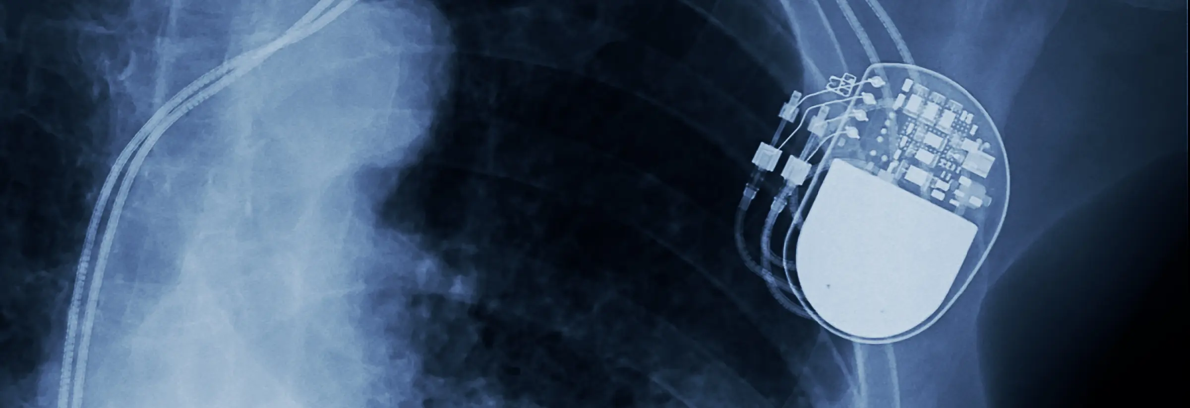 Herzschrittmacher oder Defibrillator - Die Unterschiede kennen